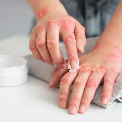 Dłonie z widoczną egzemą skóry, na które nakładany jest krem.