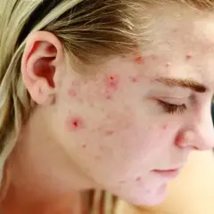 Skóra młodej osoby z widocznymi zmianami trądzikowymi, spowodowanymi przez bakterie Cutibacterium acnes.