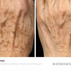 Dłoń przed i po fototerapii. Widoczne zmniejszenie przebarwień pozapalnych i plam starczych.