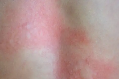 Rozległy rumień po kleszczu na skórze, z widocznymi zaczerwienieniami i delikatnymi grudkami.